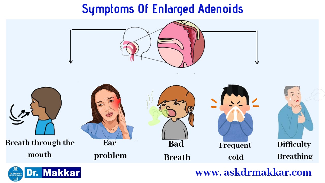 adenoid-adenoid-facies-nasal-polyp-causes-homeopathic